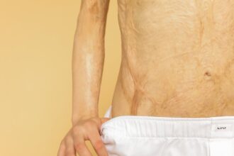 découvrez comment prévenir et traiter les brûlures cutanées, des conseils pratiques pour apaiser votre peau et favoriser une guérison rapide. informez-vous sur les types de brûlures et les soins appropriés.