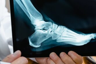 découvrez tout ce qu'il faut savoir sur la chirurgie des gencives : procédures, avantages, récupération et conseils pour maintenir une santé bucco-dentaire optimale après l'intervention.