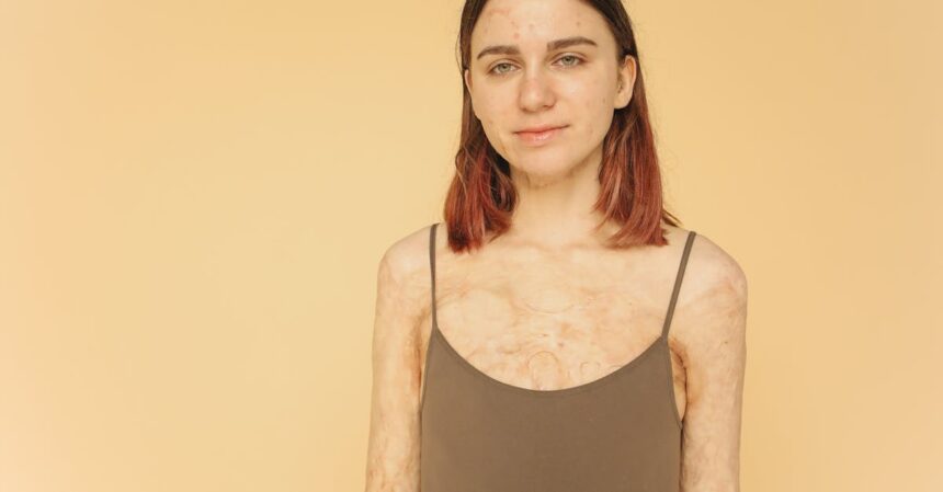 découvrez l'impact des cicatrices sur la peau et l'esprit, ainsi que des conseils pour leur traitement et leur gestion. apprenez à embrasser votre histoire tout en préservant votre beauté.