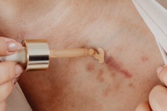 découvrez tout sur les cicatrices hypertrophiques : causes, traitements et conseils pour réduire leur apparence. apprenez à prendre soin de votre peau et à améliorer votre bien-être.