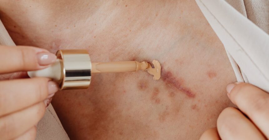 découvrez tout sur les cicatrices hypertrophiques : causes, traitements et conseils pour réduire leur apparence. apprenez à prendre soin de votre peau et à améliorer votre bien-être.
