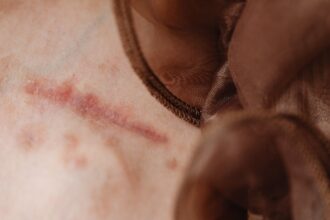 découvrez tout sur la cicatrisation des plaies : processus naturel du corps, facteurs influençant la guérison, conseils pour optimiser la récupération, et remèdes efficaces pour favoriser une cicatrisation rapide et en santé.