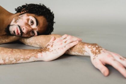 découvrez tout ce qu'il faut savoir sur la dépigmentation, ses causes, ses traitements et les meilleures pratiques pour une peau éclatante et uniforme. informez-vous sur les solutions efficaces et les précautions à prendre pour préserver la santé de votre épiderme.