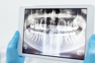 découvrez tout ce que vous devez savoir sur la parodontite, une affection dentaire courante mais sérieuse. apprenez les causes, les symptômes et les traitements disponibles pour préserver votre santé bucco-dentaire.