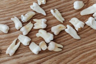 découvrez l'ulcère gingival, une forme inflammatoire de la gencive, ses symptômes, causes et traitements efficaces. informez-vous sur les meilleures pratiques de prévention pour maintenir des gencives en santé.