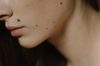 découvrez tout sur les moles : définition, types, causes, prévention et traitements. apprenez à reconnaître les signes d'alerte et l'importance des contrôles dermatologiques pour une peau en santé.