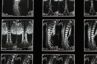 découvrez tout ce que vous devez savoir sur la sciatique : causes, symptômes, traitements et conseils pour soulager la douleur et améliorer votre qualité de vie.