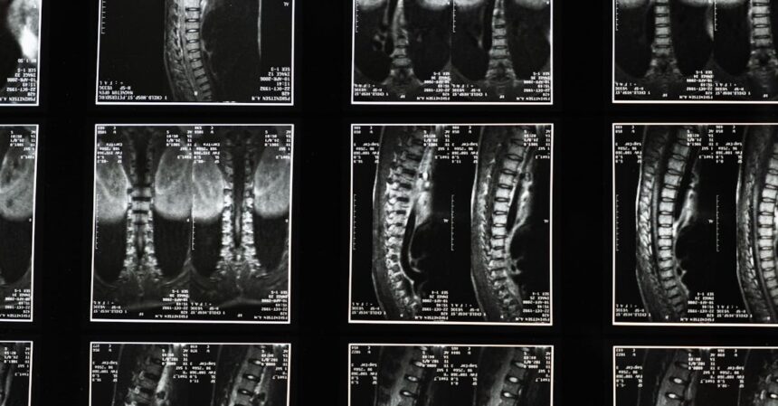 découvrez tout ce que vous devez savoir sur la sciatique : causes, symptômes, traitements et conseils pour soulager la douleur et améliorer votre qualité de vie.