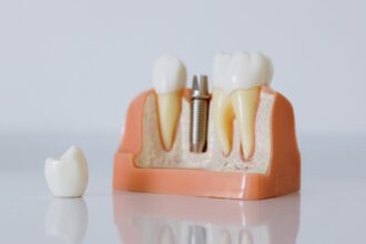 découvrez tout ce que vous devez savoir sur l'infection des implants dentaires, ses causes, symptômes, traitements et conseils pour une bonne hygiène bucco-dentaire afin de prévenir les complications.