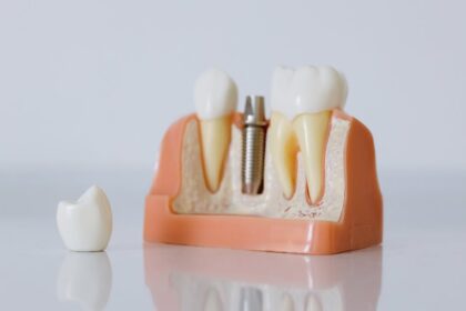 découvrez tout ce que vous devez savoir sur l'infection des implants dentaires, ses causes, symptômes, traitements et conseils pour une bonne hygiène bucco-dentaire afin de prévenir les complications.