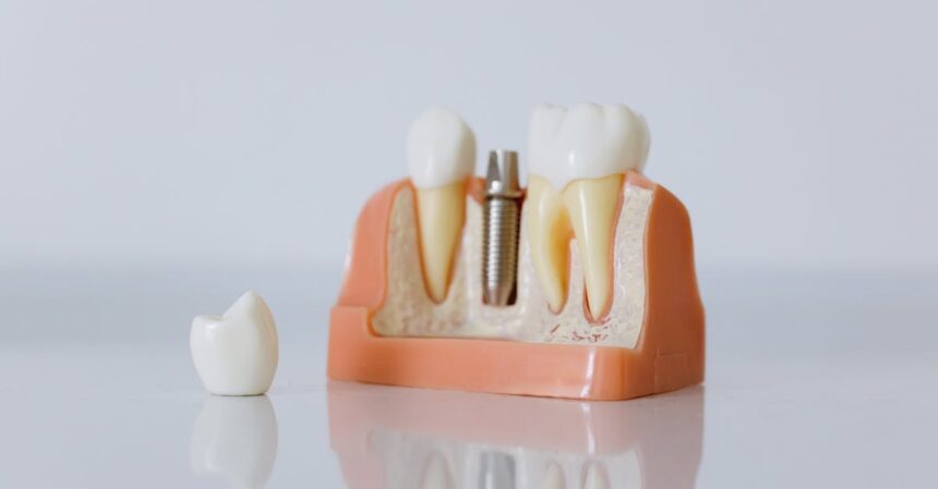 découvrez tout ce que vous devez savoir sur l'infection des implants dentaires, ses causes, symptômes, traitements et conseils pour une bonne hygiène bucco-dentaire afin de prévenir les complications.