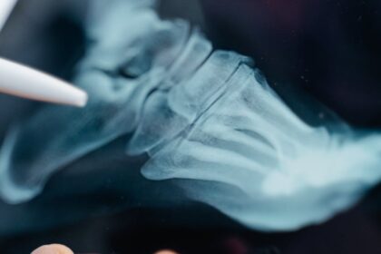 découvrez des conseils essentiels pour maintenir une bonne santé osseuse, apprendre comment renforcer vos os, et prévenir les maladies liées à la dégradation osseuse. adoptez des habitudes saines pour un squelette robuste et durable.