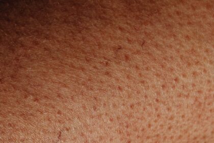 découvrez des solutions efficaces pour traiter les imperfections cutanées. apprenez à améliorer l'apparence de votre peau grâce à des conseils de soins, des produits adaptés et des astuces pour retrouver un teint éclatant et uniforme.