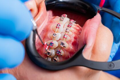 découvrez les problèmes d'alignement dentaire, leurs causes et les solutions possibles. apprenez comment un bon alignement peut améliorer votre santé bucco-dentaire et votre sourire.