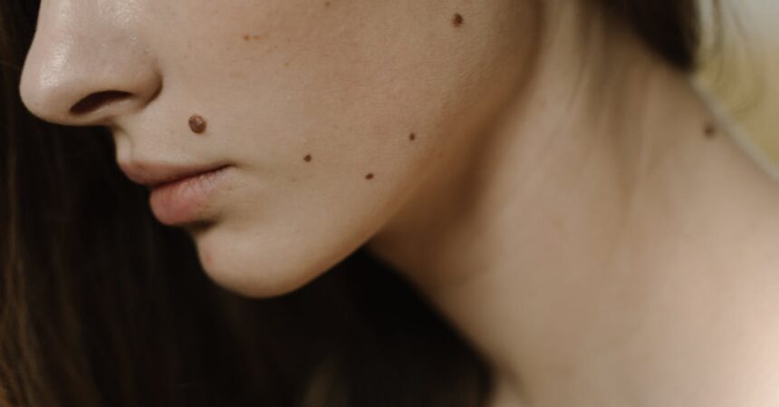 découvrez tout sur les moles : types, caractéristiques, soins et conseils pour leur gestion. informez-vous sur leur signification dermatologique et apprenez à les reconnaître pour préserver votre santé.