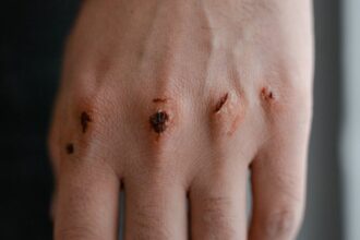 découvrez les causes, symptômes et traitements des traumatismes de la main. informez-vous sur les différentes blessures, leur prévention et les meilleures pratiques pour favoriser une guérison rapide et efficace.
