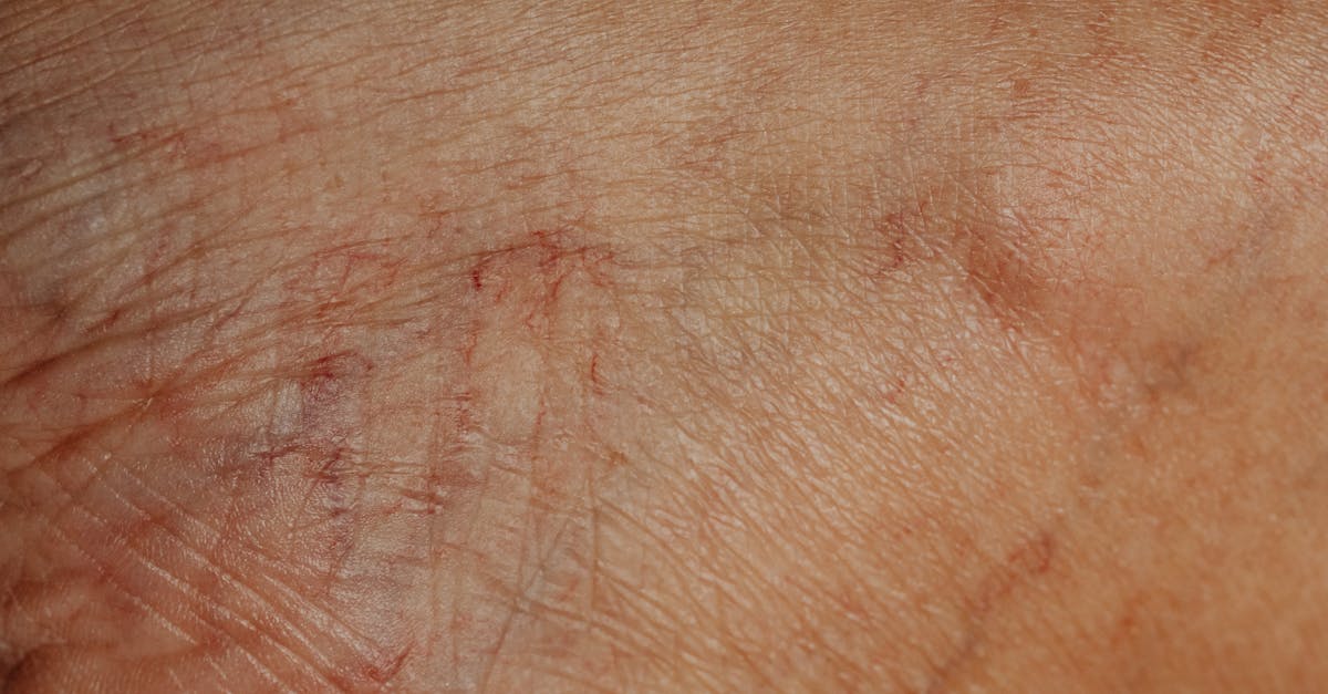 découvrez tout sur la mycose cutanée, une infection fongique affectant la peau. apprenez les symptômes, les causes, les traitements et les conseils pour prévenir cette affection dermatologique courante.