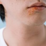découvrez tout ce que vous devez savoir sur l'herpès labial : causes, symptômes, traitements et conseils pour soulager les poussées. protégez vos lèvres et apprenez à mieux gérer cette affection courante.