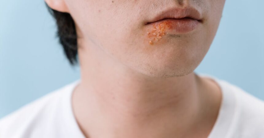 découvrez tout ce que vous devez savoir sur l'herpès labial : causes, symptômes, traitements et conseils pour soulager les poussées. protégez vos lèvres et apprenez à mieux gérer cette affection courante.