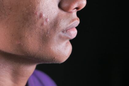 découvrez tout ce qu'il faut savoir sur la dermatite : causes, symptômes, traitements et conseils pour soulager cette affection cutanée. retrouvez des astuces pour mieux gérer la dermatite au quotidien.