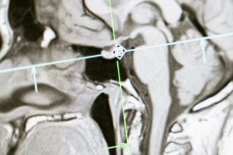 découvrez tout sur l'irm : une technique d'imagerie médicale sans douleur qui permet de visualiser l'intérieur du corps avec précision. informez-vous sur son fonctionnement, ses applications et son importance dans le diagnostic médical.
