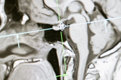 découvrez tout sur l'irm : une technique d'imagerie médicale sans douleur qui permet de visualiser l'intérieur du corps avec précision. informez-vous sur son fonctionnement, ses applications et son importance dans le diagnostic médical.