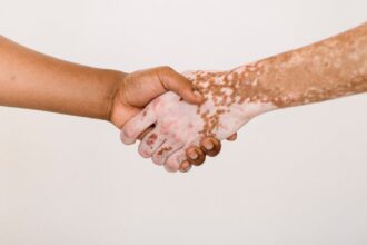découvrez tout ce qu'il faut savoir sur le psoriasis : causes, symptômes, traitements et conseils pour mieux vivre avec cette maladie de la peau. informez-vous pour mieux comprendre et gérer votre santé.