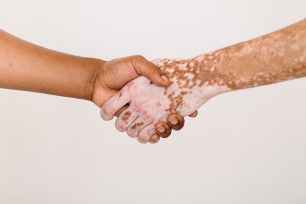 découvrez tout ce qu'il faut savoir sur le psoriasis : causes, symptômes, traitements et conseils pour mieux vivre avec cette maladie de la peau. informez-vous pour mieux comprendre et gérer votre santé.