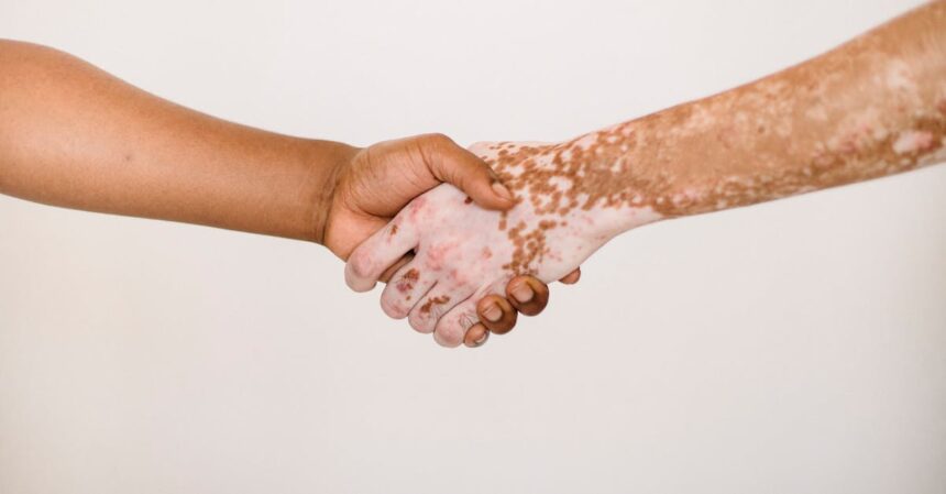 découvrez tout ce qu'il faut savoir sur le psoriasis : causes, symptômes, traitements et conseils pour mieux vivre avec cette maladie de la peau. informez-vous pour mieux comprendre et gérer votre santé.
